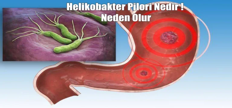 Helikobakter Pilori mide kanserine neden olur mu?