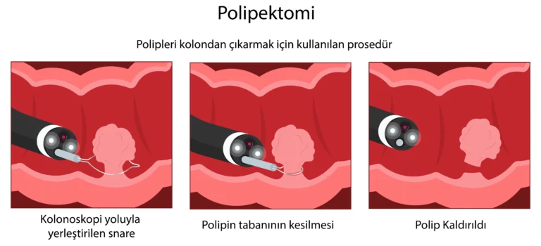 Kolon (Kalın Bağırsak) Polipleri Nedir?