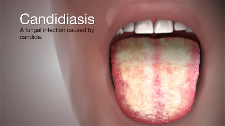 Candida özofajiti nedir?