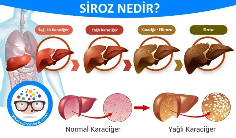 Siroz nedir?