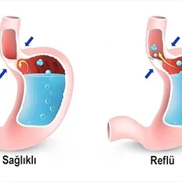Gastroözofageal Reflü Nedir?