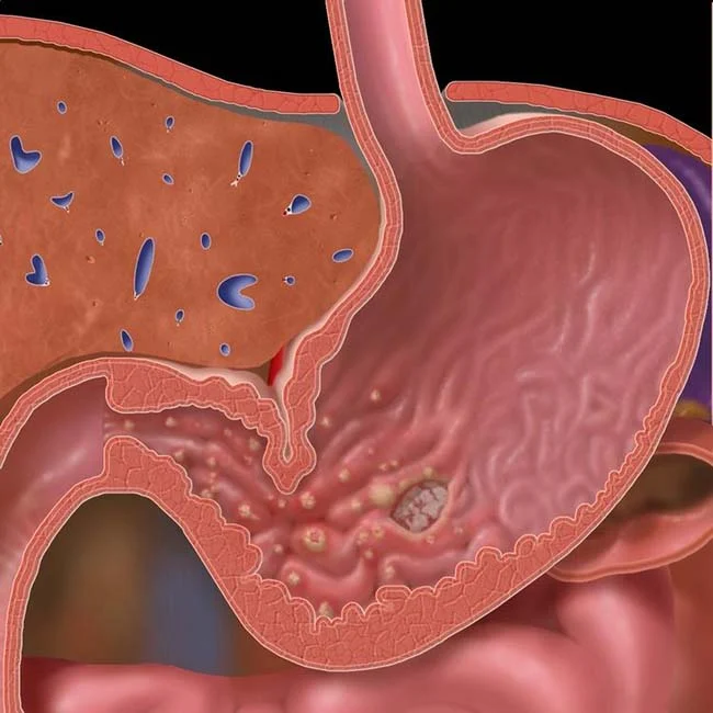 Antral gastrit