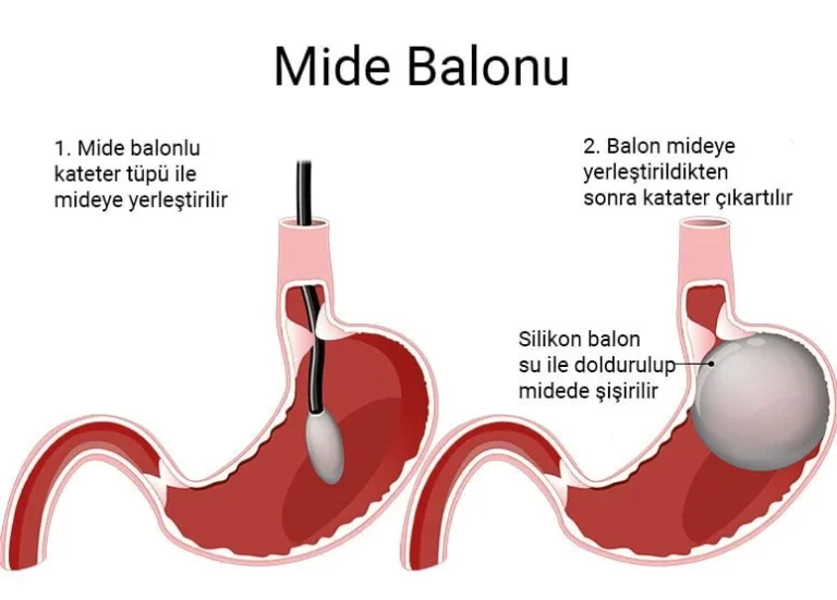 Mide balonu nasıl uygulanır?