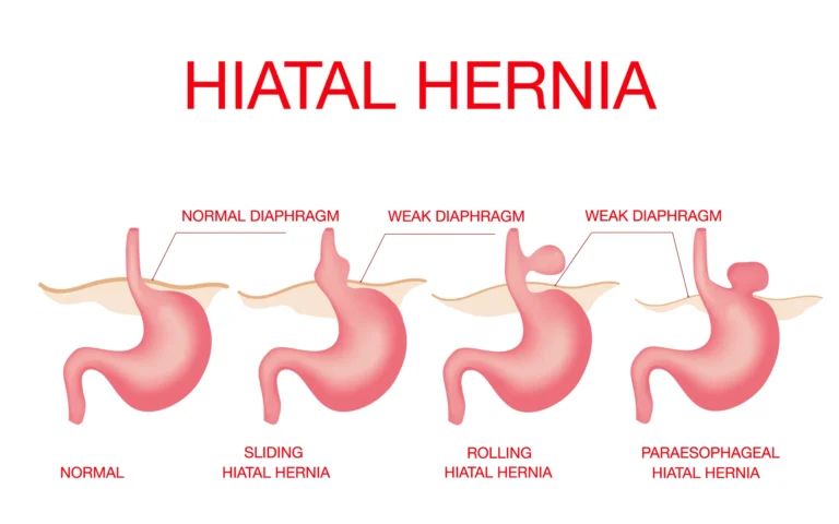 Hiatal herni nedir?