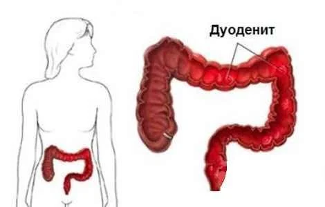 Duodenit