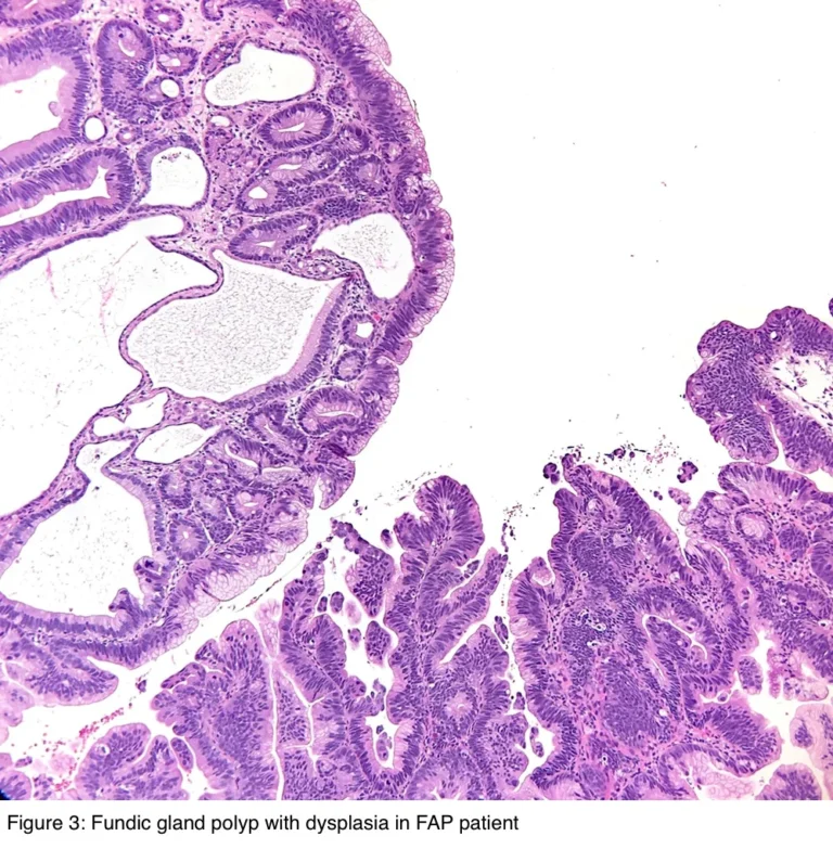 Fundik gland polipleri